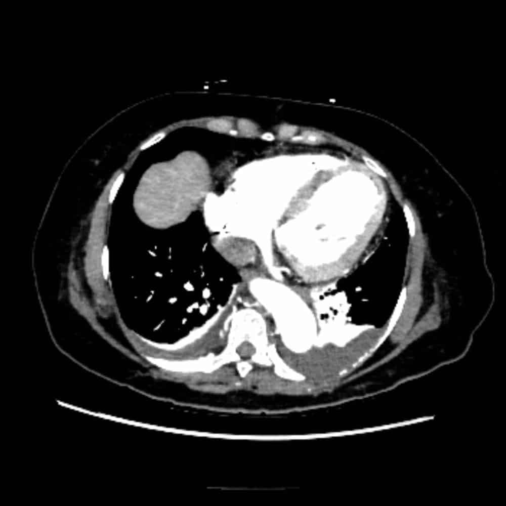 Viz™ AORTIC