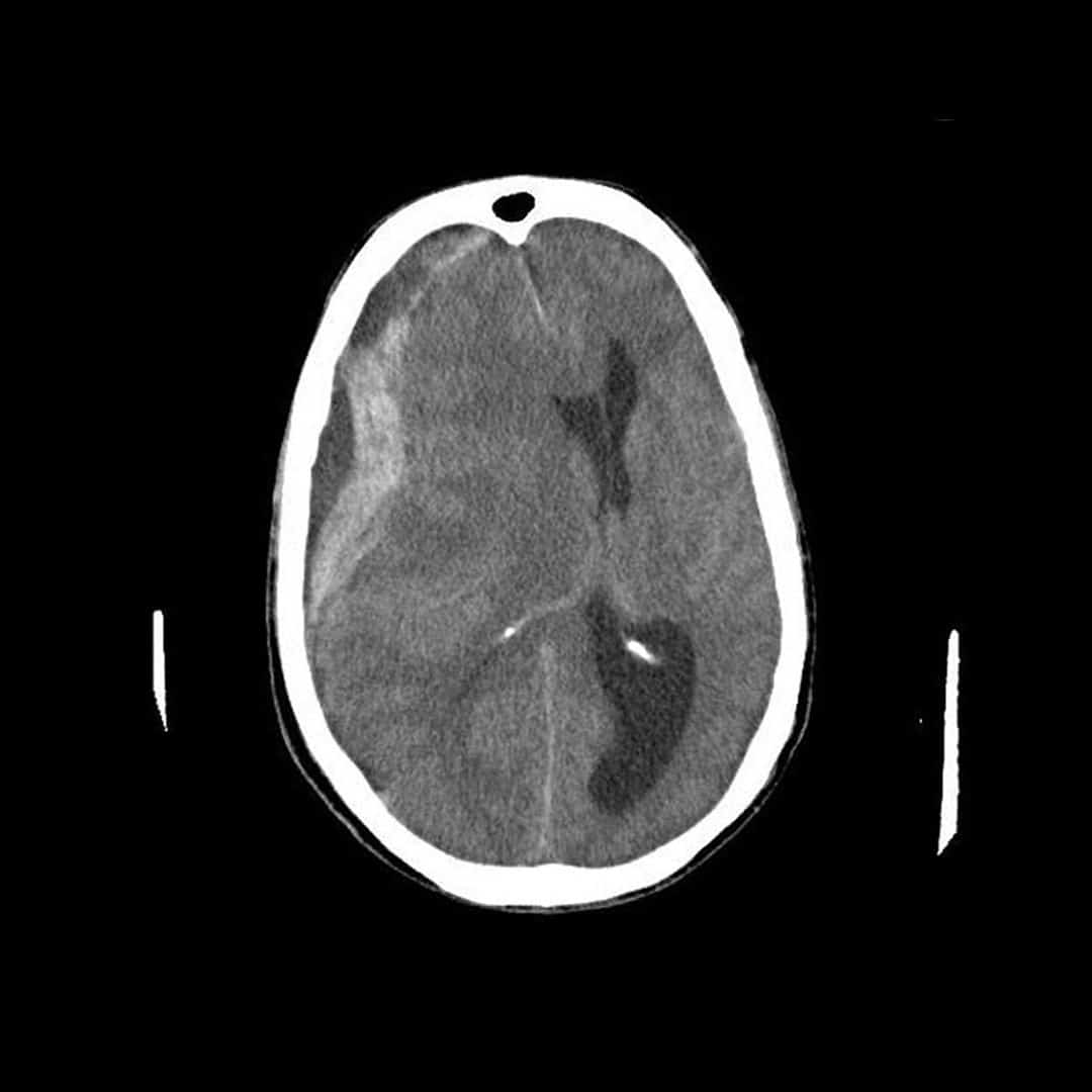 SUBDURAL