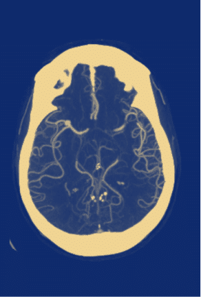 An x-ray scan of a human brain