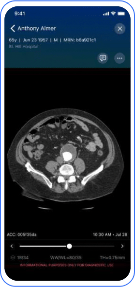 Aortic Disease