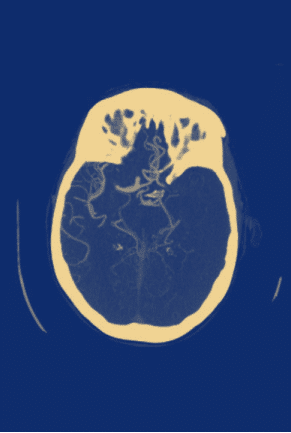 Radiology scan of a large vessel occlusion (LVO) stroke