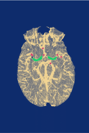 Computed tomography (CT) perfusion imaging scan