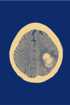 Intracerebral hemorrhage (ICH) scan