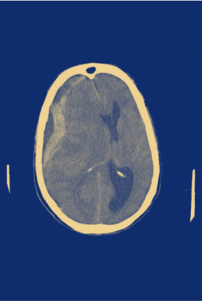 Radiology scan of a possible subdural hematoma