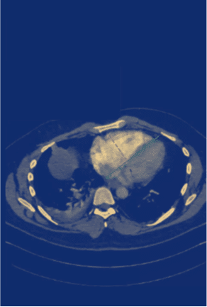 Radiology scan to detect a suspected pulmonary embolism (PE).