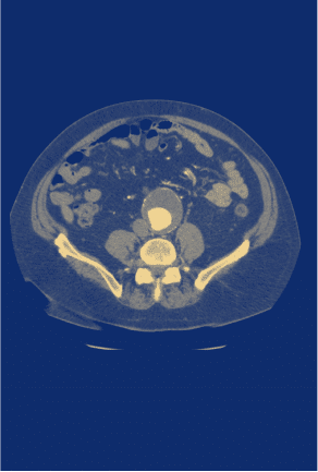 An x-ray scan of a suspected abdominal aortic aneurysm (AAA).