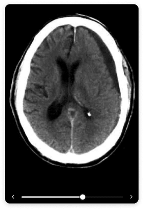 subdural-inset