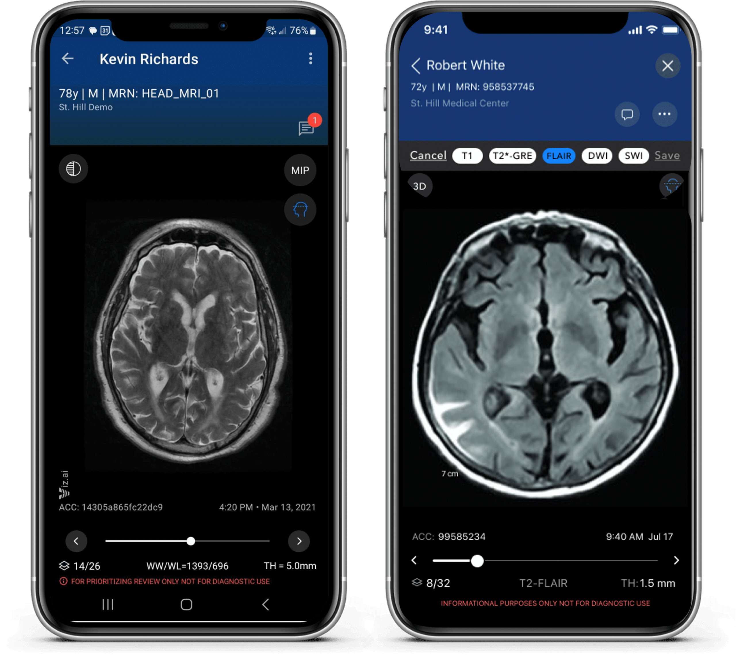 Two smartphone screens showing MRI scans of the human brain
