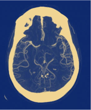 An X-ray scan of a human brain